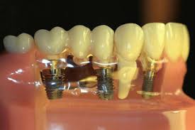 зубные импланты